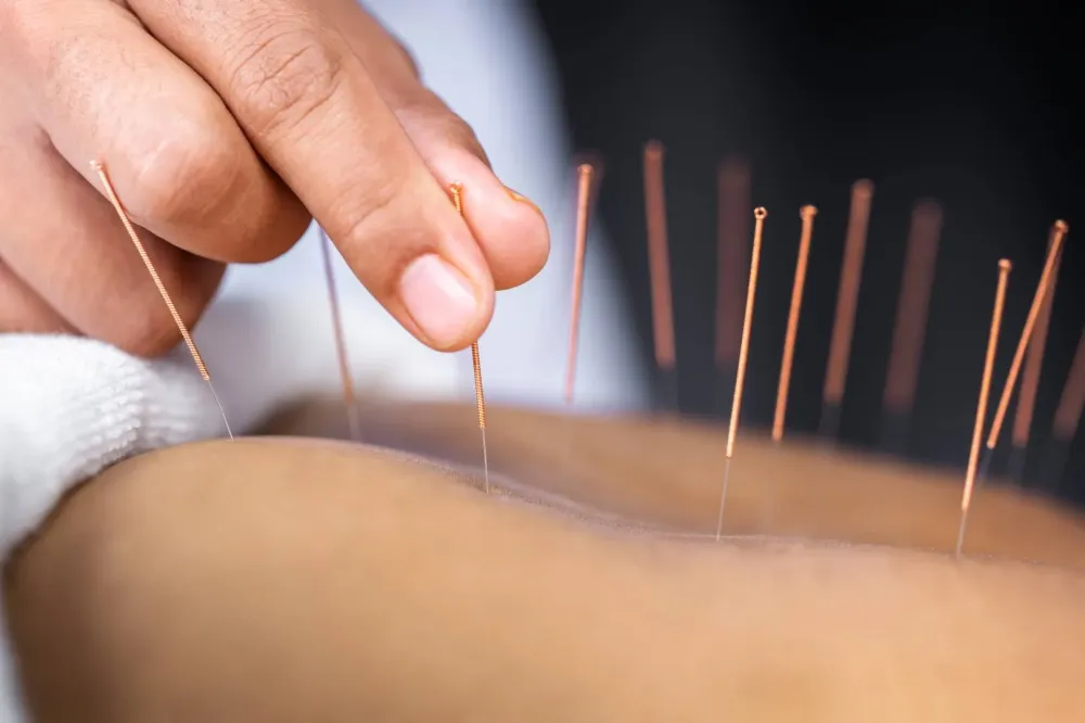 Acupuncture à Billère